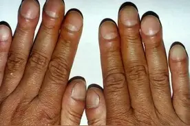 体内有癌，手指先知？提醒：手指出现5个异常，或是癌症的信号图片