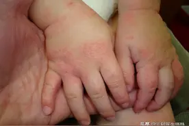 小手密集的小疙瘩是什么东东？图片