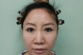 45岁来北京做拉皮手术，术后3个月变化大，恢复期差点崩溃图片