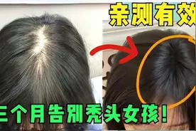 头顶炸毛了！这三个防脱生发好物绝了！秃头星人千万不要错过！图片