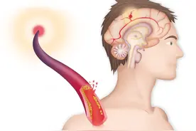 您真的了解“脑梗”吗？深谈脑梗发生时应该怎么做，生活怎样预防图片