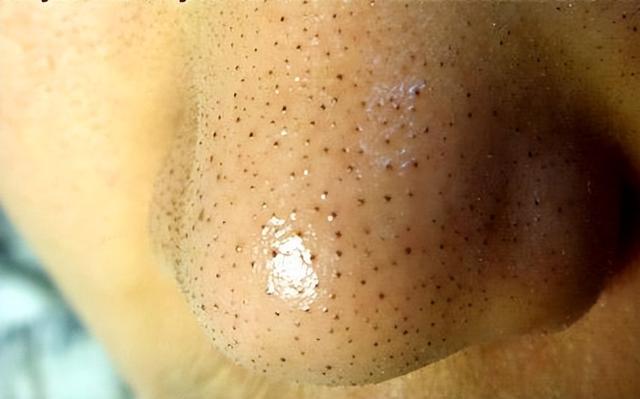 鍘婚粦澶翠骇鍝佺湡鐨勯潬璋卞悧锛熺毊鑲ょ鍖荤敓甯︾潃鍘婚粦澶存敾鐣ヨ蛋鏉ヤ簡