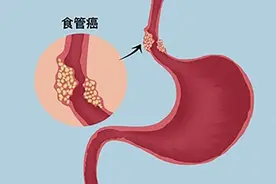 食道癌发现即晚期？6个早期信号莫轻视！图片