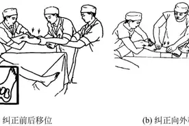 胫腓骨骨折的临床处理对策图片
