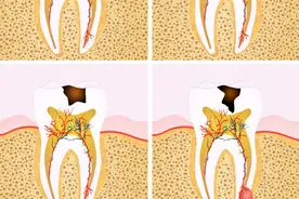 牙齿烂了一半，还有补牙的必要吗？直接拔了不是更省事吗？图片