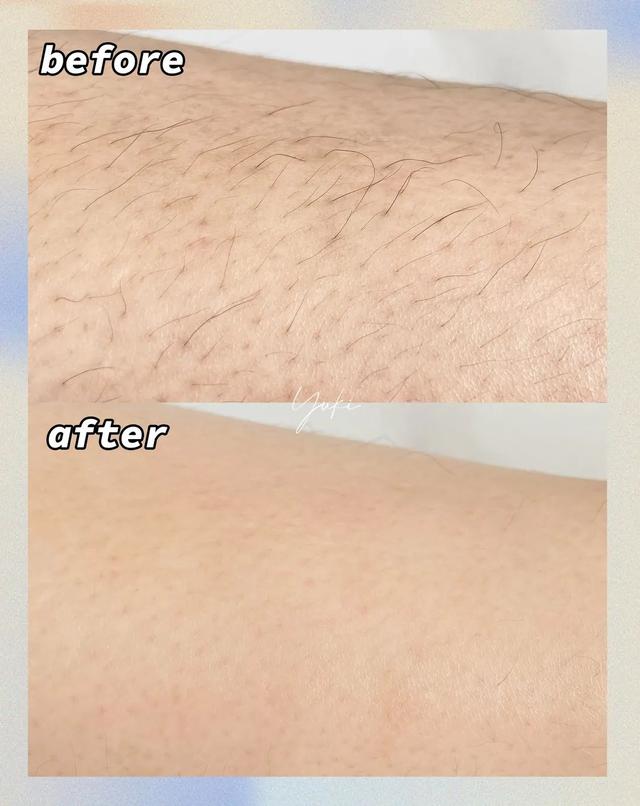 冰点脱毛以后可以擦身体乳吗