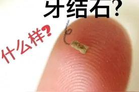 “牙结石”可以自己抠掉吗？教你几招，牙缝脏东西或能轻松掉图片