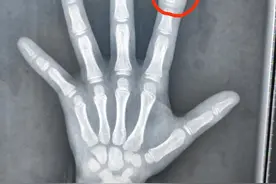 啃得光秃秃！9岁女孩长期啃指甲引发感染致骨髓炎图片