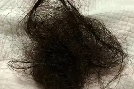 惊人！生发竟如此简单，过来人自用“内+外”疗法，发量暴增图片