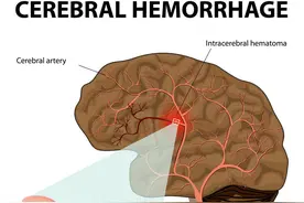 提醒：脑溢血到来之前，身体常常有5个“预警”，发现后及时处理图片