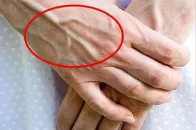 有的人手臂“青筋暴起”，有的人几乎看不到青筋哪种比较健康？图片