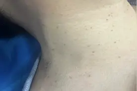 脖子上长了很多“小疙瘩”？不出意外可能是这种疾病，要警惕！图片