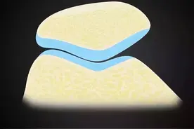 康复诊疗平台丨上下楼膝盖疼？中年人要当心“髌骨软化症”！图片