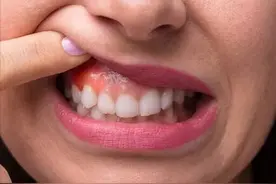 牙龈肿一个月了，不消肿怎么办？图片