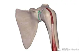 一种常见的肩部损伤——SLAP损伤的诊断与治疗图片