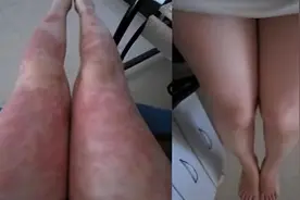 夏季牛皮癣，抓住这个时机！3个专用药帮你消退皮损，不复发。图片