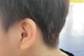江苏女子耳朵褶皱层叠形似“饺子”，网友却称一见就要跑：摔跤耳图片