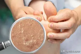 脚气和脚臭是一码事儿吗？全网最全干货，摆脱脚臭、脚痒、脚脱皮图片