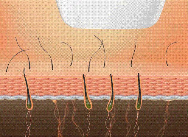 冰点脱毛以后可以擦身体乳吗