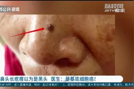 鼻头长疙瘩以为是黑头 医生：是基底细胞癌图片