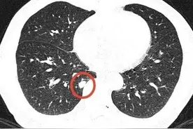 肺结节诊治实例(10)：如何看待肺癌7种抗体对肺结节的诊断价值图片