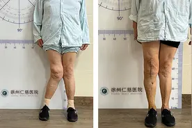 膝关节重度外翻畸形犹如“沙漏”，智能导航下应如何“捋直”？图片