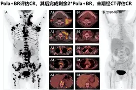 南大一附院多学科协作实施高难度TIPS手术 难治性淋巴瘤患者再获新生图片