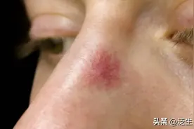 身上长出这种痣，必须警惕！图片