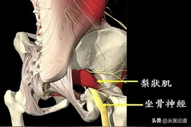 谈一谈梨状肌综合征图片