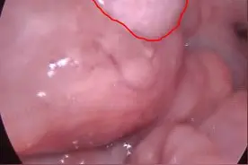 扁桃体肿物，严重吗，看看这些图就知道了图片