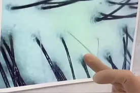发顶植发花了6万，还是取自己的毛囊移植，到底值不值图片