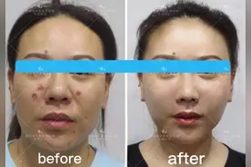 从来没听说过的“面部支架提升”，竟然给我这么大的惊喜图片