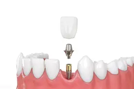 刚种好的牙怎么就自己掉了呢？说说种植牙的早期失败图片