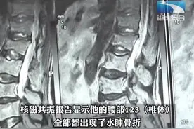 7旬大爷腰椎骨折难下床 医生：腰部出现病症别指望“躺好”图片