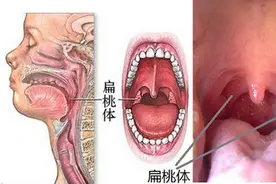 不要小看扁桃体，这个东西发炎了，会引起大麻烦图片