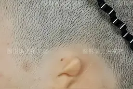 发病率仅次于唇腭裂的小耳畸形，这个黄金手术年龄要切记图片