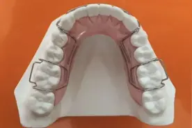 矫正后选择哪种保持器佩戴比较好？图片
