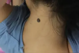 医生提醒：若黑痣长在这3个部位，要密切关注，及早做检查图片