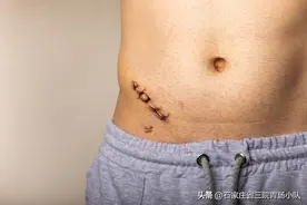 得了阑尾炎必须手术吗？图片