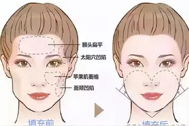 别随便做脂肪填充面部！分享我做脂肪填充的经历，以及常见问题图片