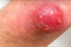 当心“小疖”成“大劫”——长了疖肿要早治图片