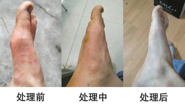 角化型脚气很痒怎么办