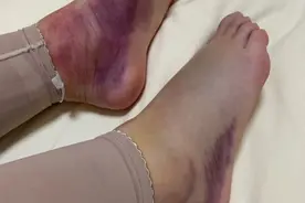 揭秘：做吸脂到底是一种怎么样的体验？别被市场的营销洗了脑图片