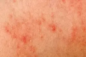 接触性皮炎会有哪些症状，该注意什么？图片