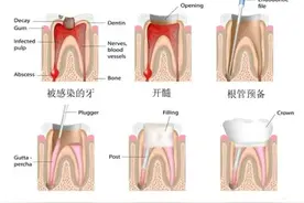 牙齿刚做完了根管治疗，术后应该注意什么？图片