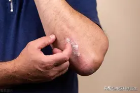 5000多元没能治好的湿疹，50元中药缓解了，中医用了哪些药材？图片