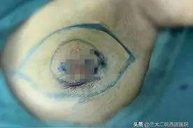 【医疗动态】兰大二院西固医院普外二科为84岁高龄患者成功实施乳腺癌前哨淋巴结活检+患侧乳腺全切术图片