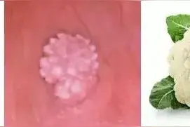 尖锐湿疣和珍珠疹，如何鉴别？图片