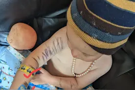 痴迷于创可贴的娃，这是什么心理？谁知道图片