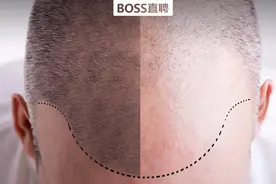 月薪7万节假日无休，90后发际线危机“养活”了多少植发师？图片